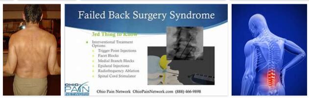 Failed back surgery syndrome